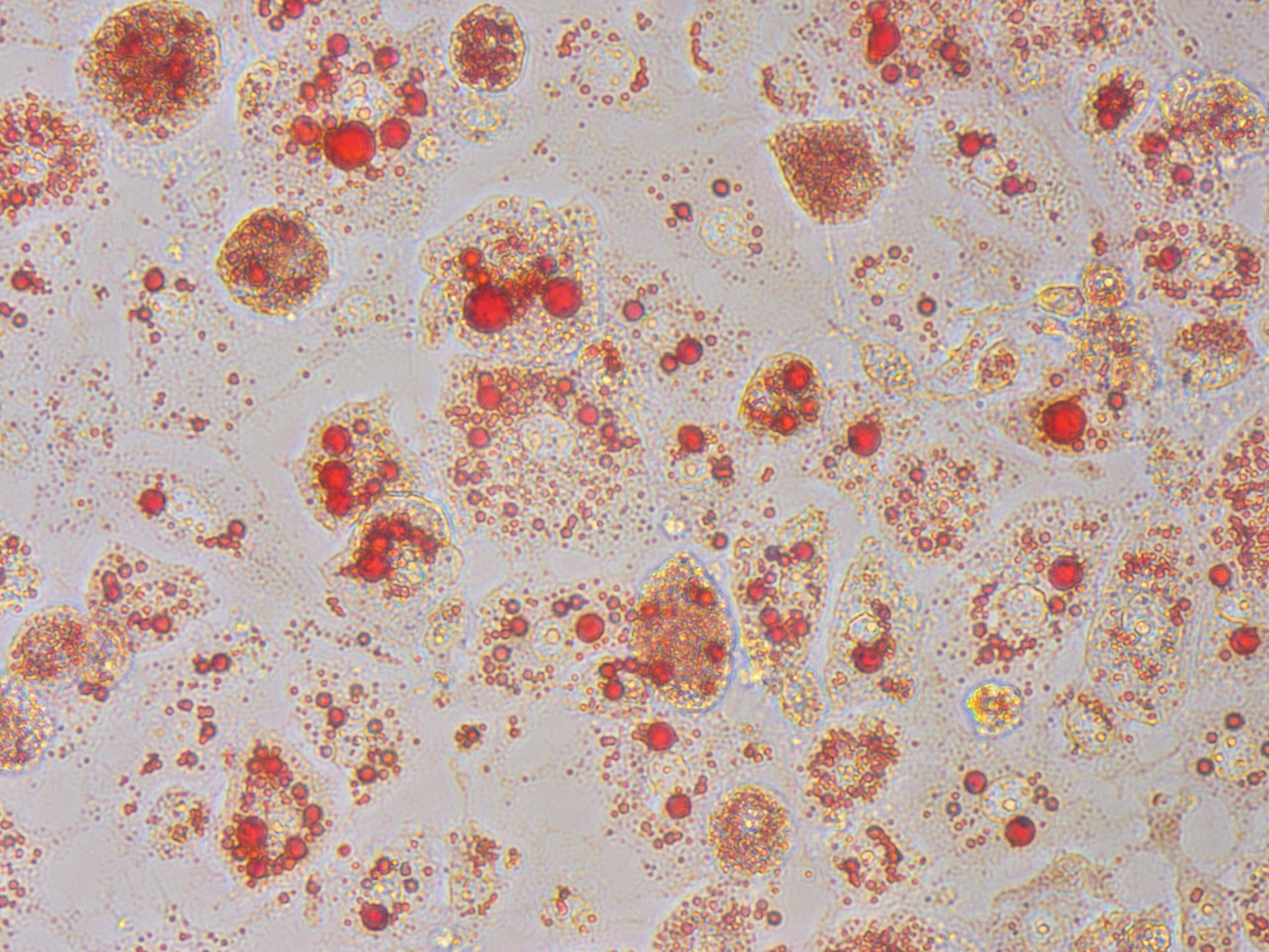 pathogenesis of type 2 diabetes mellitus 